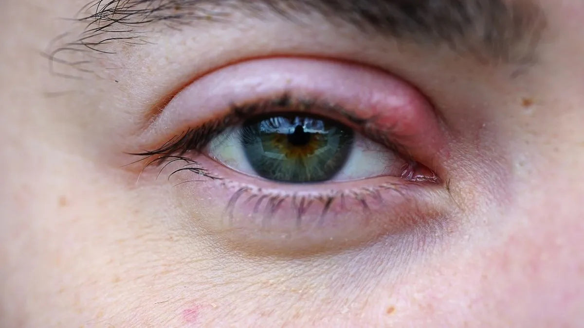 Warm compress on eyelid for stye treatment