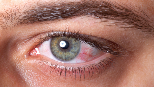 7 Reasons Your Eyes Are Red and Itchy: What You Need To Know