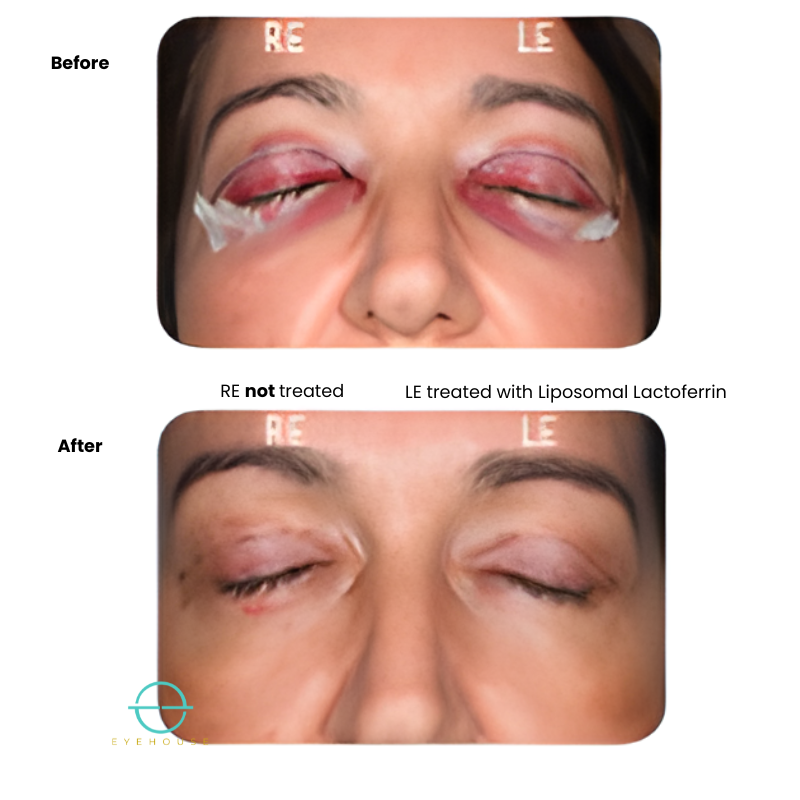 Bruise-eze® - Sterile Lactoferrin Topical - 5pack