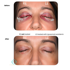 Bruise-eze® - Sterile Lactoferrin Topical - 5pack