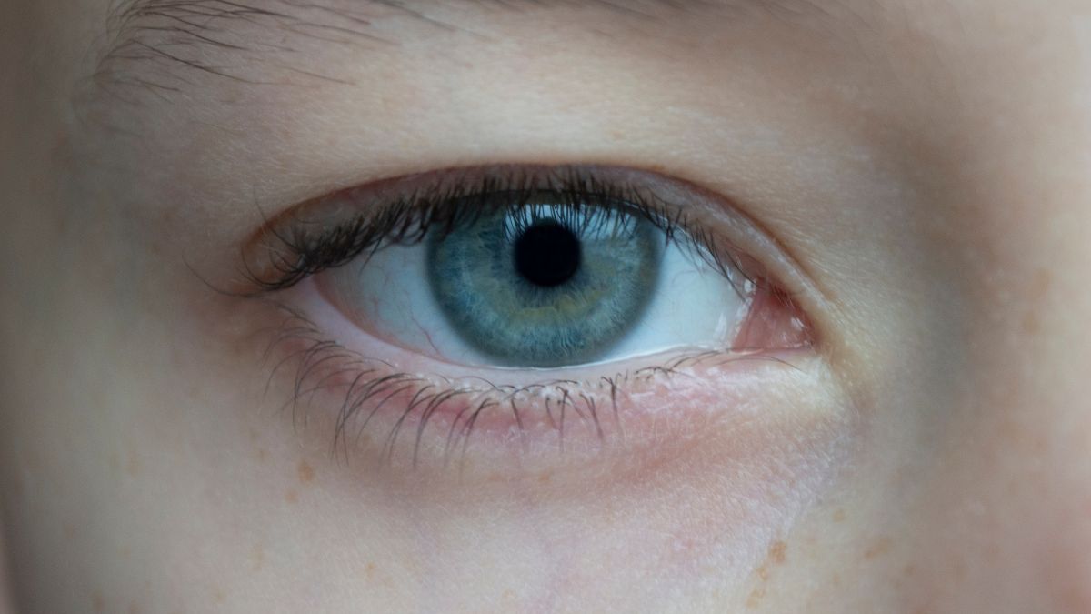 Eye with lower lid redness, blepharitis, caucasian.