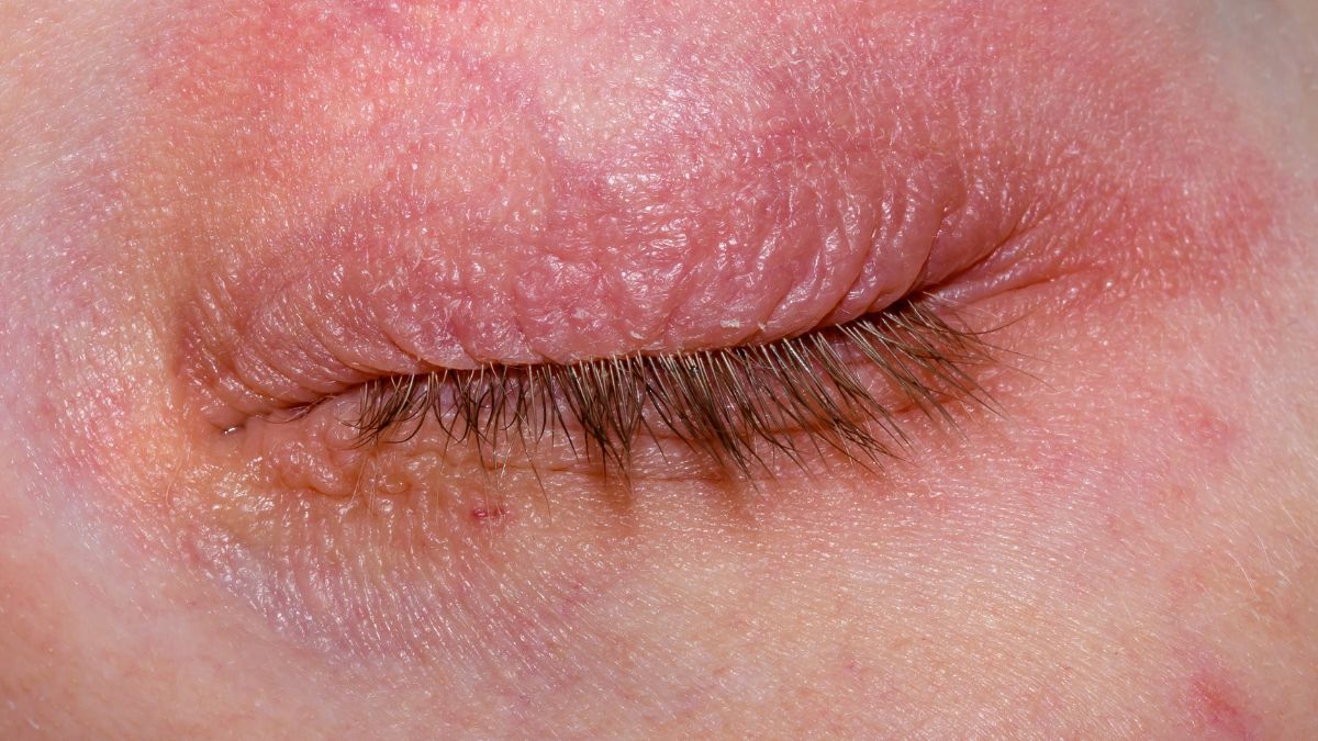 eye_closed_skin_irritation_around_eyelid._eczema._blepharitis